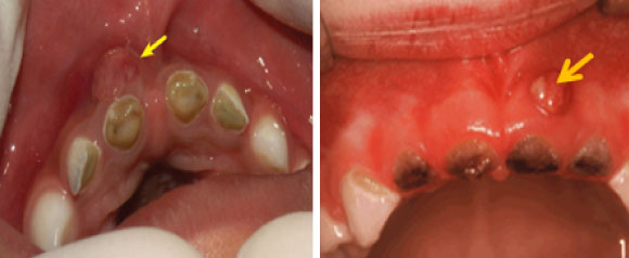 Posledice karijesa ranog detinjstva