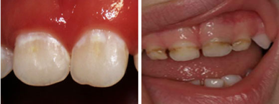 Prvi znaci karijesa ranog detinjstva