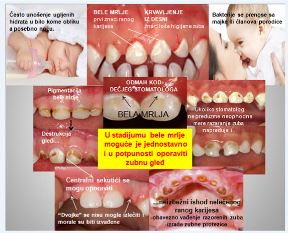 Različiti stadijumi karijesa