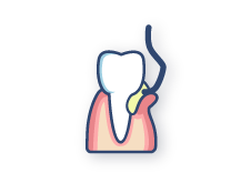 paradontalna hirurgija