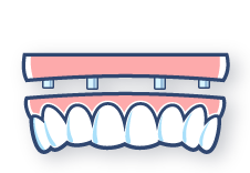 proteze na implantima